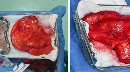 One Kilogram Lipoma Removed from the Back – Restoring Mobility
