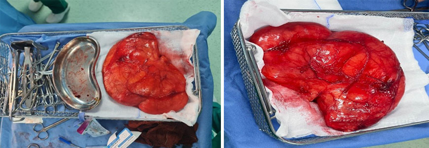 One Kilogram Lipoma Removed from the Back β Restoring Mobility